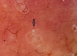 10 ngày điều trị sùi mào gà tại phòng khám tư không đỡ, vào viện phát hiện nguyên nhân do mắc bệnh ghẻ