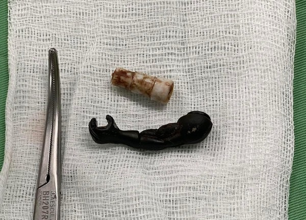 Bác sĩ gắp ra cánh tay siêu nhân, đầu bút...từ âm đạo bé 5 tuổi
