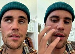 Justin Bieber hủy toàn bộ chuyến lưu diễn còn lại vì hậu chứng liệt nửa mặt