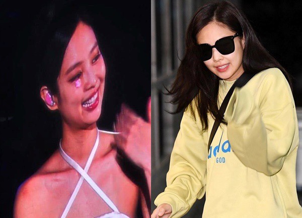 Cận cảnh vết thương ngay gần vị trí nhạy cảm của Jennie (BLACKPINK): Liệu nhan sắc có bị ảnh hưởng?