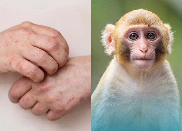 TP.HCM: Bộ Y tế đề nghị xác định nguồn lây 2 ca mắc đậu mùa khỉ, người dân sống trong nỗi lo mới