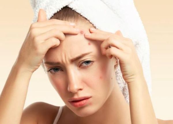 Nặn mụn thế nào để da không bị sẹo?