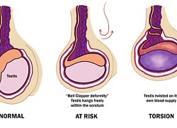 Nam sinh đột ngột đau bìu dữ dội, đến viện tinh hoàn đã tím đen