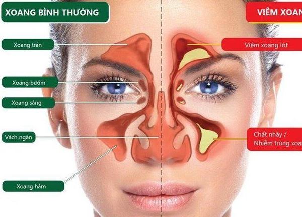 Các loại viêm xoang thường gặp và triệu chứng