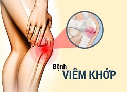 Cách điều trị bệnh viêm khớp hiệu quả