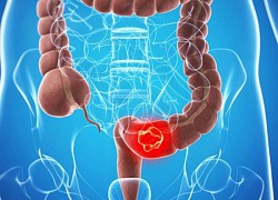 Đột phá trong nghiên cứu phát hiện sớm ung thư ruột