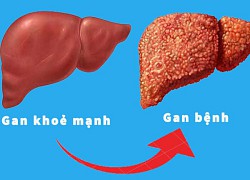 Mắc viêm gan B có chữa khỏi được không?