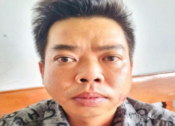Mâu thuẫn vì lời bài bài hát, người đàn ông bị chém lìa bàn tay