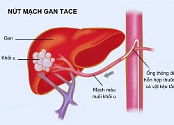 Điều trị ung thư gan bằng phương pháp can thiệp nội mạch cho cụ ông U90