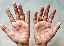 Đức ghi nhận ca đầu tiên nhiễm biến thể mới của virus đậu mùa khỉ