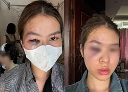 Vụ đi trang điểm đám cưới, thợ makeup tố bị em gái cô dâu "tương tác" bầm tím mắt: Hai bên nói gì?