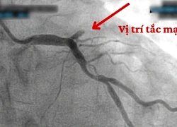 Vì sao biến cố tim mạch gia tăng vào mùa lạnh?