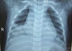 Uống dầu hỏa, bé trai 14 tháng tuổi nguy kịch