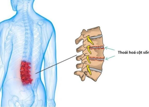 4 giai đoạn của bệnh thoái hóa cột sống thắt lưng và phương pháp điều trị