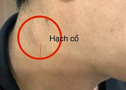 Đi khám do triệu chứng nuốt nghẹn, bất ngờ phát hiện ung thư thực quản