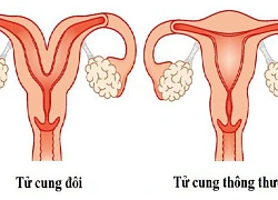 Bị dị tật tử cung đôi có sinh con được không?