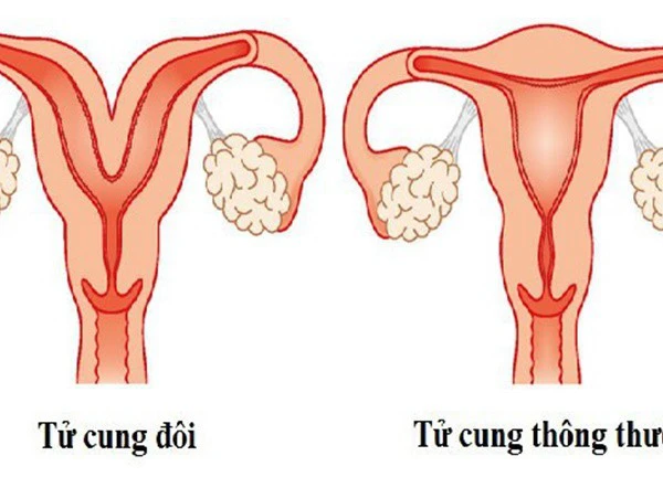 Bị dị tật tử cung đôi có sinh con được không?