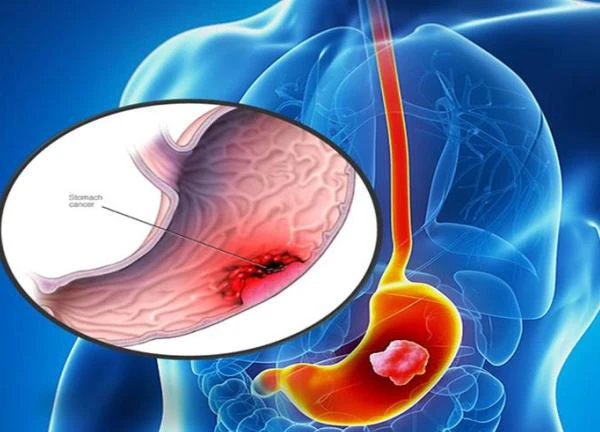 Chuyên gia ung bướu cảnh báo tác nhân gây ung thư dạ dày