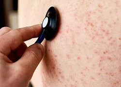 Nhiều trường hợp mắc rubella, dấu hiệu nào nhận biết bệnh sớm?