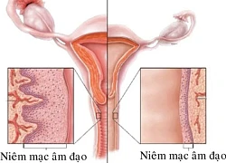 Mệt mỏi, lo lắng, căng thẳng cũng gây khô, teo âm đạo và cách cải thiện