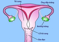 Viêm vùng chậu là bệnh gì, có gây vô sinh không?