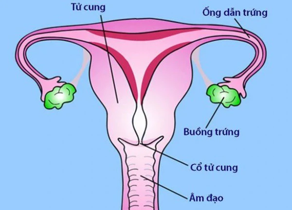 Viêm vùng chậu là bệnh gì, có gây vô sinh không?