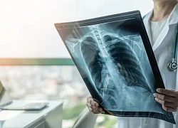 Yếu tố tăng nguy cơ mắc ung thư ở người trẻ