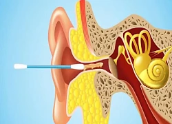 Lấy ráy tai không đúng cách nguy hiểm như thế nào?