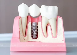 Điều gì khiến cấy ghép Implant 'đắt xắt ra miếng'