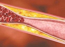 Một số thay đổi lối sống có thể giúp giảm mức cholesterol xấu