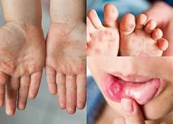 Đồng Nai: Số ca mắc tay chân miệng tăng vọt so với cùng kỳ