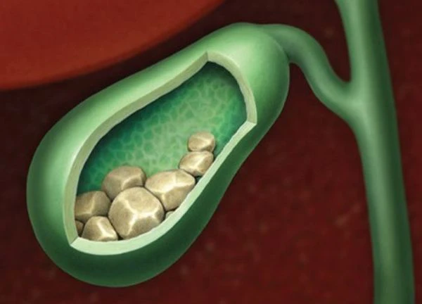 Sỏi mật: Nguyên nhân, triệu chứng, điều trị và cách phòng ngừa