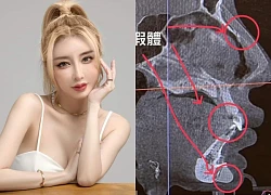 Sốc: Sao nữ nghiện "dao kéo" tung ảnh chụp X-quang khuôn mặt với dị vật 3cm tồn tại trong cằm suốt 8 năm