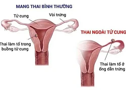 Câu hỏi thường gặp về mang thai ngoài tử cung