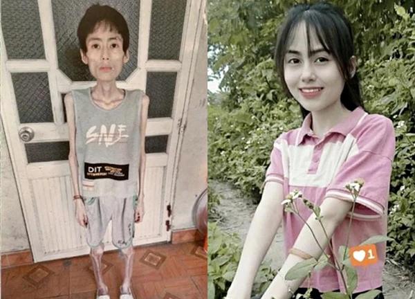 Cô gái Hưng Yên nhịn ăn giảm cân, từ xinh xắn đầy sức sống giờ còn da bọc xương