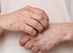Số ca mắc bệnh đậu mùa khỉ tăng theo cấp số nhân tại CHDC Congo