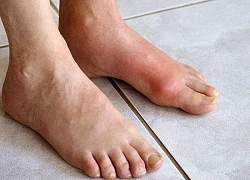 5 lý do khiến bạn dễ mắc gout