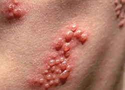 Nhiễm virus Herpes sau khi xăm làm đẹp