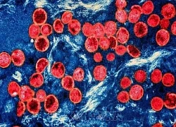 Giới nghiên cứu: Virus gây bệnh đậu mùa khỉ đang biến đổi nhanh hơn bình thường