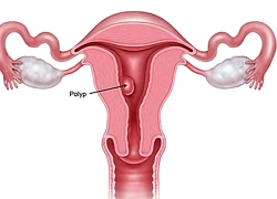 Ra huyết sau mãn kinh Cẩn thận bệnh nguy hiểm!