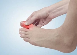 Thời tiết nắng nóng cẩn thận với cơn gout cấp