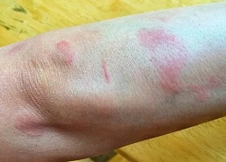 Biểu hiện của lupus ban đỏ như thế nào?