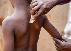 UNICEF thúc đẩy bảo đảm việc mua vaccine phòng bệnh đậu mùa khỉ