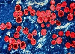 Virus gây bệnh đậu mùa khỉ lây lan khắp 5 khu vực ở châu Phi