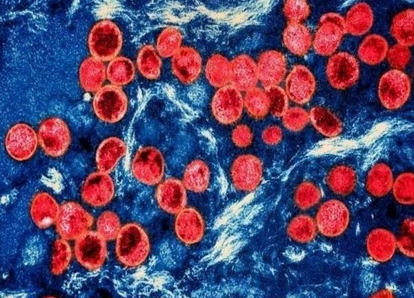 Pháp phát hiện ca nhiễm biến thể mới của virus đậu mùa khỉ