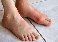 Nam thanh niên 17 tuổi đã mắc bệnh Gout