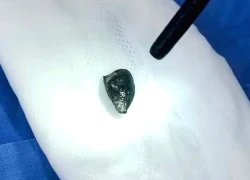 Bất ngờ phát hiện hạt hồng xiêm bị 'bỏ quên' hơn 10 năm trong phế quản
