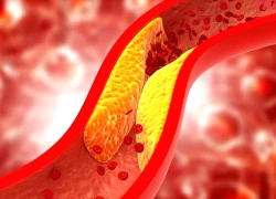 Bí quyết cải thiện xơ vữa động mạch
