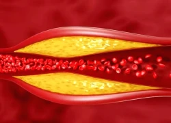 Cách kiểm soát cholesterol ở mức an toàn nhất