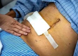 Căn bệnh gây tử vong cao nhất trong các loại ung thư
